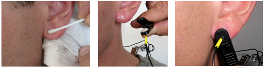 preparation and placement